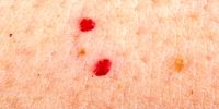 علت بروز لکه‌های قرمز کوچک روی پوست چیست؟