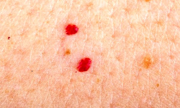 علت بروز لکه‌های قرمز کوچک روی پوست چیست؟