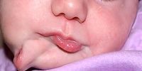 این کودک با دو دهان متولد شد+عکس