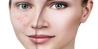 نخ‌ها و کلاژن‌های جذبی باید تحت نظر پزشک استفاده شوند