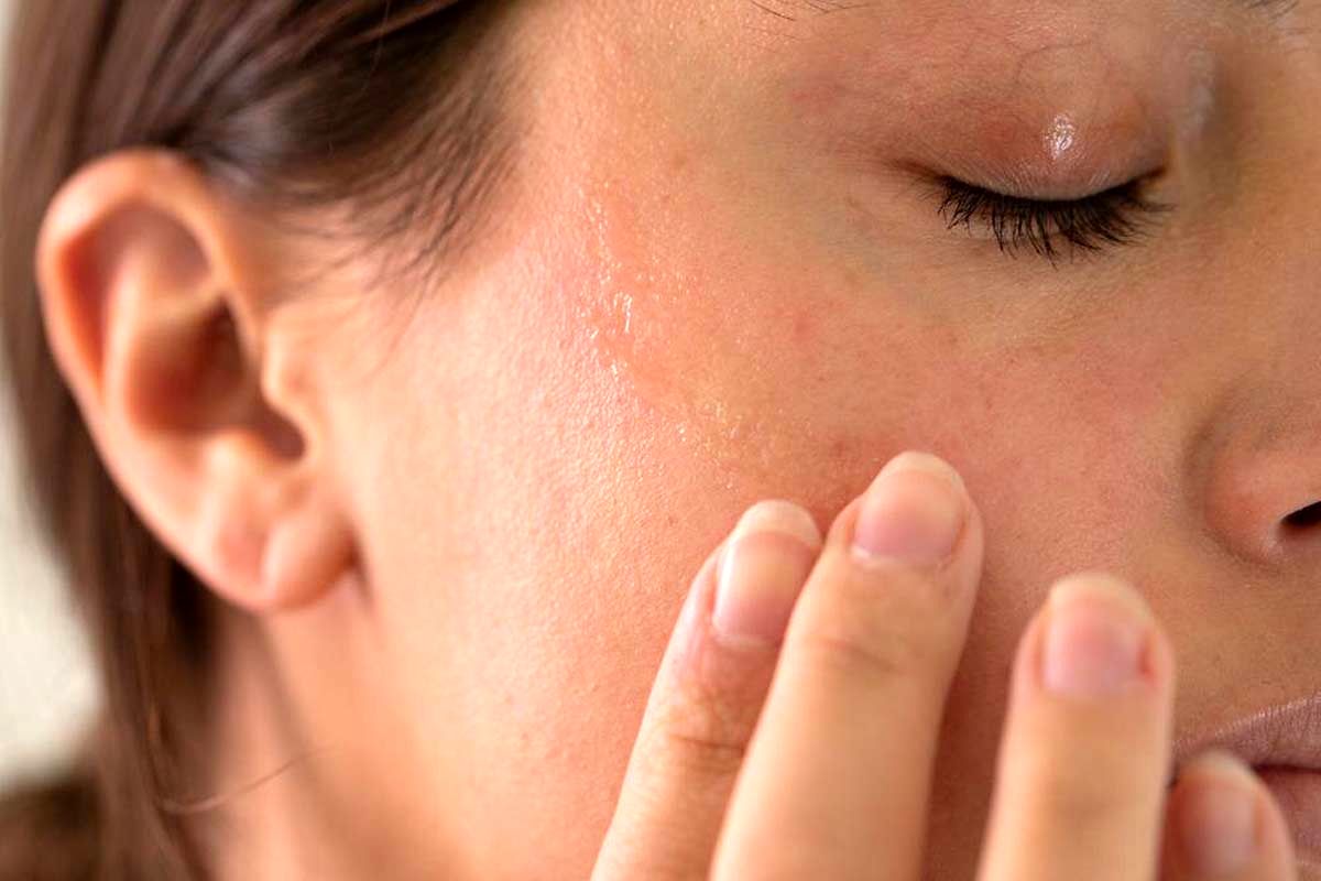 چه زمانی نگران کبودی های روی پوست شوید؟