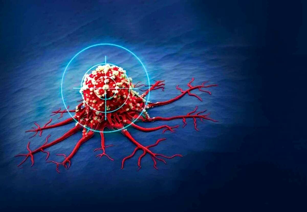 هشدار؛ علامت خطرناک ابتلا به سرطان روده بزرگ را بشناسید