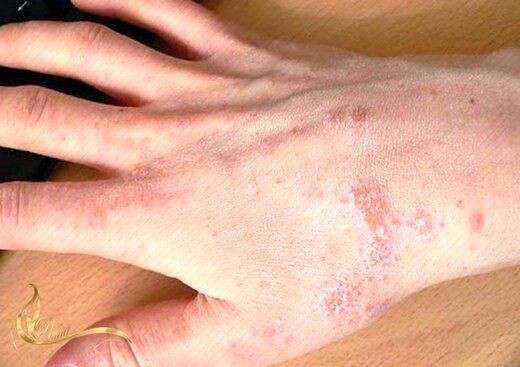 آلرژی عجیب که زنان بیشتر درگیرش می‌شوند+عکس