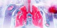 علائم عفونت ریه چیست و چه کسانی بیشتر در معرض ابتلا هستند؟