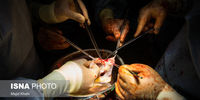 گزارش جالب از چهارمین جراحی پیوند گردن در جهان توسط پزشکان ایرانی!