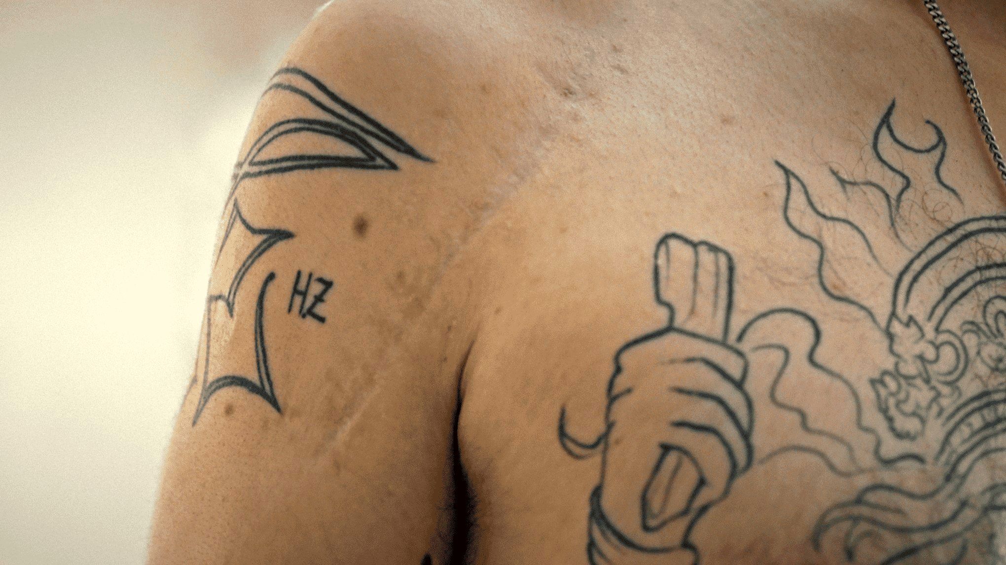 یک جای زخم بلندِ جراحی که از روی سینه و شانهٔ آرش دربندی امتداد دارد