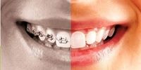 با انواع ارتودنسی دندان و جدیدترین روش ارتودنسی آشنا شوید