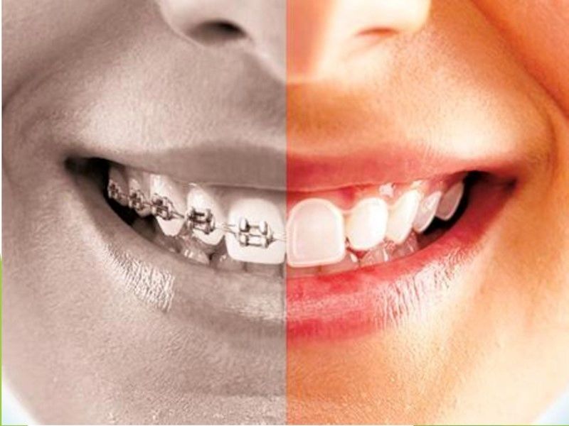 با انواع ارتودنسی دندان و جدیدترین روش ارتودنسی آشنا شوید