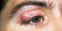 نشانه های ترسناکی که خبر از بیماری چشم می‌دهند
