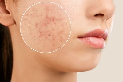 آکنه در بزرگسالی خطر ابتلا به اختلالات خوردن را افزایش می‌دهد
