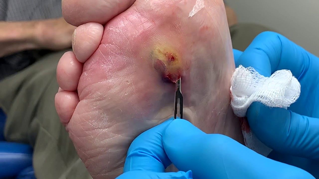 چرا نباید به تاول های پا دست زد +روش درمان 