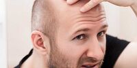 این اختلال روانی «کچلتان» می‌کند