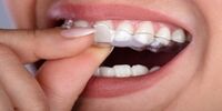 ارتودنسی نامرئی و پر طرفدارترین نوع آن