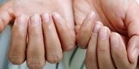 راهکار مقابله با کرونا برای مبتلایان به اگزما و حساسیت های پوستی