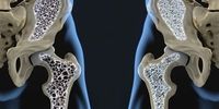 6 علامت هشدار دهنده پوکی استخوان در مردان