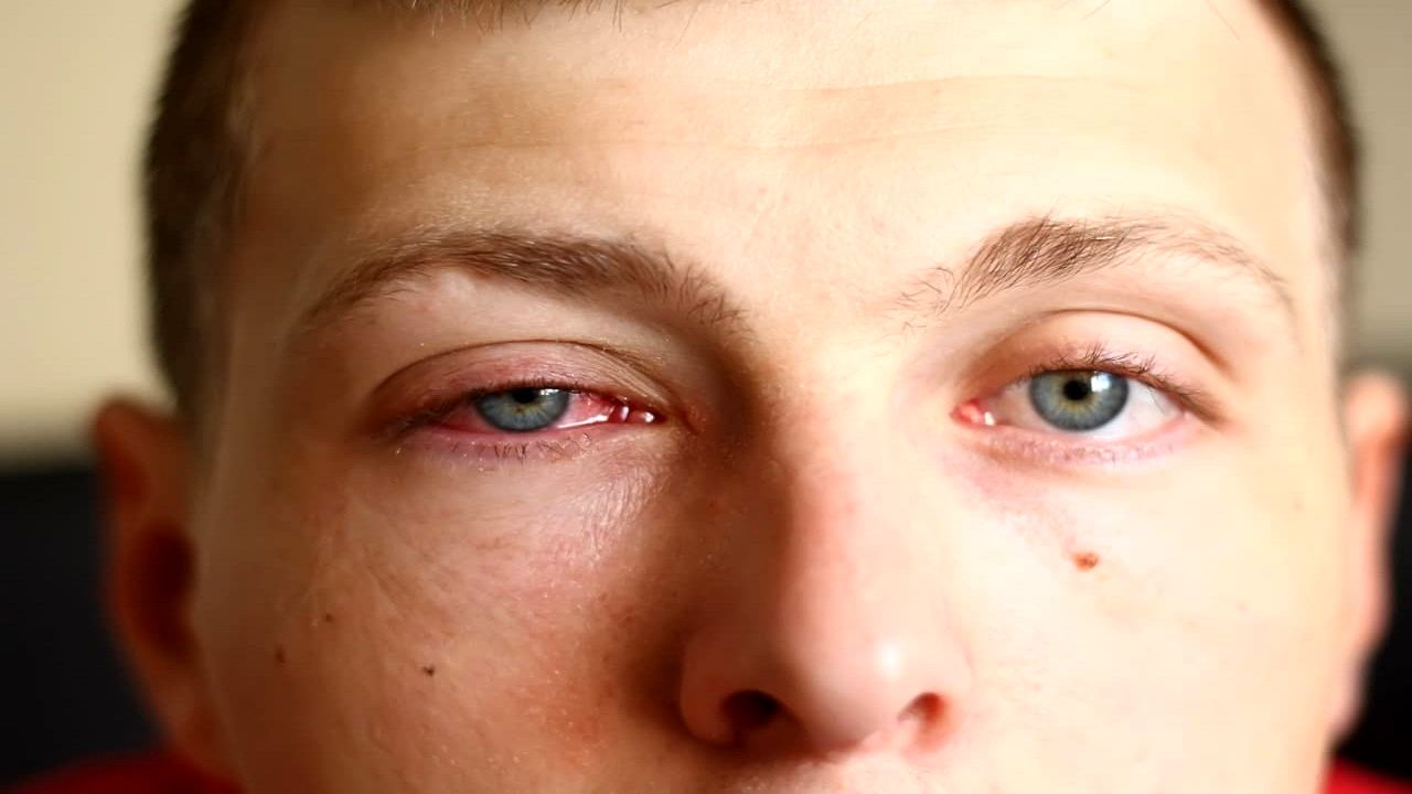 راه تشخیص قرمزی چشم ناشی از کرونا چیست؟