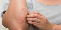 خارش و آلرژی شدید؛ ارمغان مصرف ۹ ماده غذایی
