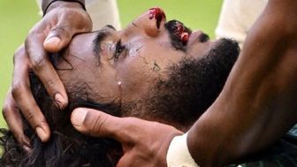 اتفاق وحشتناک در بازی های جام جهانی/ جمجمه بازیکن عربستان خرد شد+ عکس
