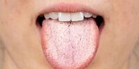 همه‌چیز درباره دلایل سفید شدن زبان