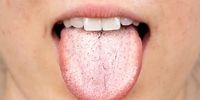همه‌چیز درباره دلایل سفید شدن زبان