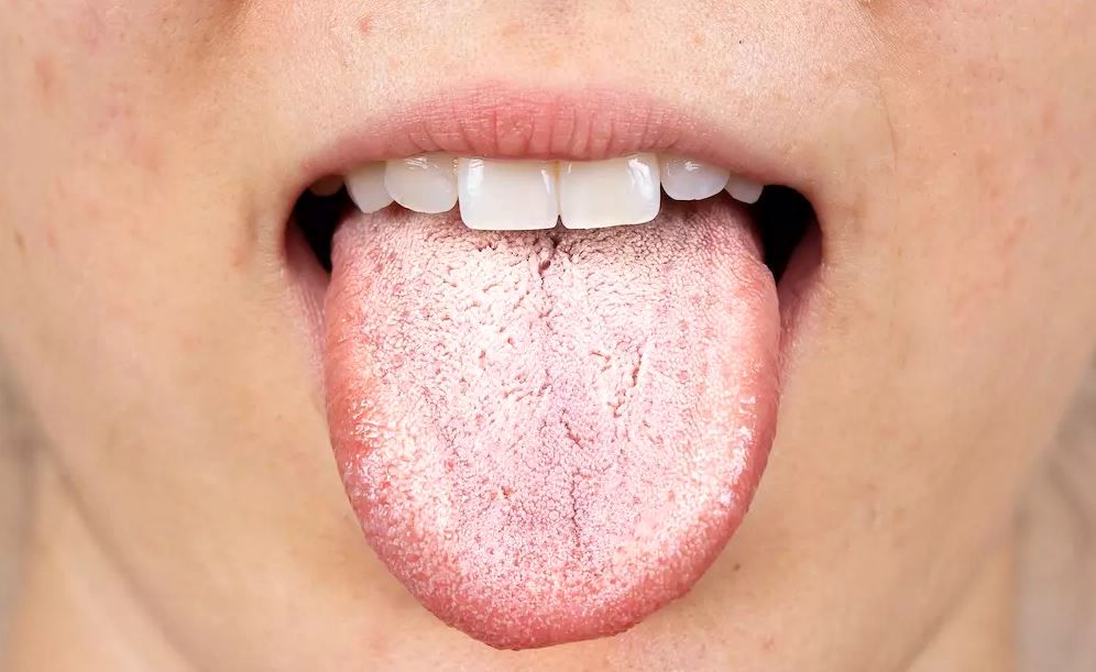 همهچیز درباره دلایل سفید شدن زبان