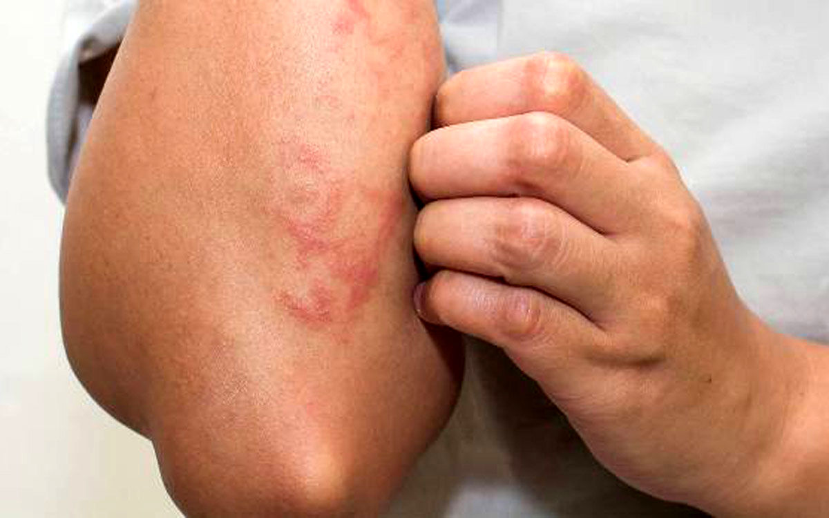 اگر این علائم را بر روی پوستتان دارید شاید کرونا گرفته باشید 