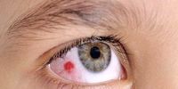 نشانه سرطان چشم را بشناسید 