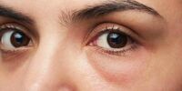 چگونه از شر پف زیر چشم راحت شویم؟