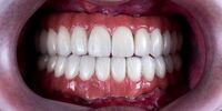 مقایسه ایمپلنت دیجیتال و سنتی؛ دقت میلی‌متری در طراحی لبخند