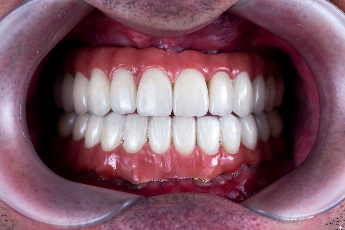 مقایسه ایمپلنت دیجیتال و سنتی؛ دقت میلی‌متری در طراحی لبخند