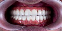 مقایسه ایمپلنت دیجیتال و سنتی؛ دقت میلی‌متری در طراحی لبخند