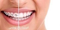 آیا ارتودنسی دندان هایی که روکش یا لمینت دارند امکان پذیر است؟