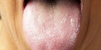 سلامت زبان را جدی بگیرید/ چگونه زبان خود را تمیز کنیم؟

