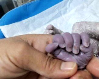 یک نوزاد عجیب‌الخلقه در عراق متولد شد!+تصاویر