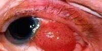 این علائم را که نشان دهنده سرطان چشم هستند جدی بگیرید