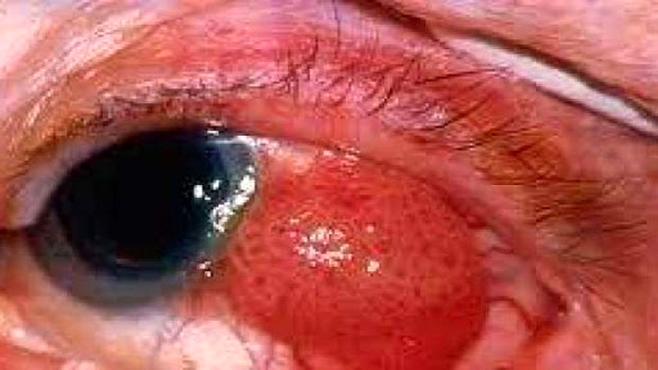 این علائم را که نشان دهنده سرطان چشم هستند جدی بگیرید