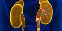 دفع سنگ کلیه با این ترکیب ساده خانگی 
