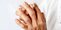 این نوع تغییر شکل انگشتان دست نشاندهنده ابتلا به یک بیماری خطرناک است!