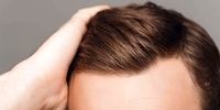 علت چرب شدن موی سر چیست ؟