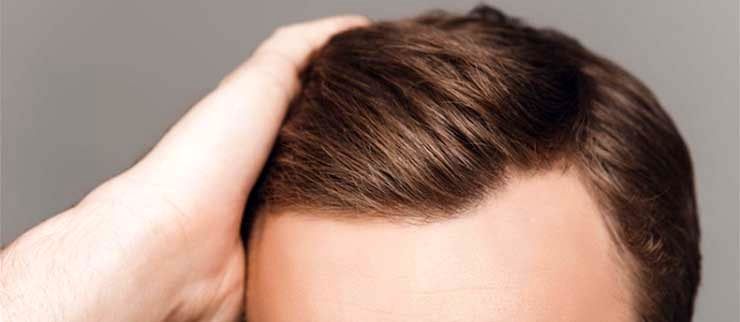 علت چرب شدن موی سر چیست ؟