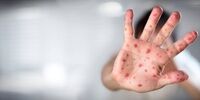 هشدار جدی در مورد شیوع آبله میمون در کشور / غافلگیر نشویم