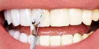 5 اشتباه رایج که باعث زردی دندان ها می شود