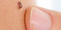 چرا خال‌ها به خارش می‌افتند؟

