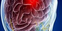 درمان مرگبارترین تومور‌های مغزی با چند راهکار ساده