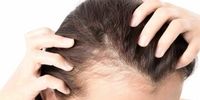 اگر ریزش مو دارید این 4 اقدام را جدی بگیرید