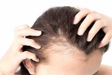 اگر ریزش مو دارید این 4 اقدام را جدی بگیرید