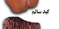 سیروز کبدی را از این راه تشخیص دهید