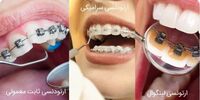 معرفی انواع ارتودنسی ثابت
