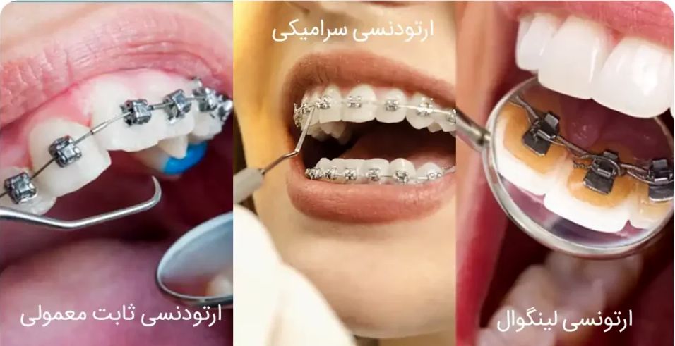 معرفی انواع ارتودنسی ثابت