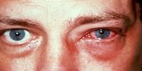 اثرات مخرب سرماخوردگی بر سلامت چشم
